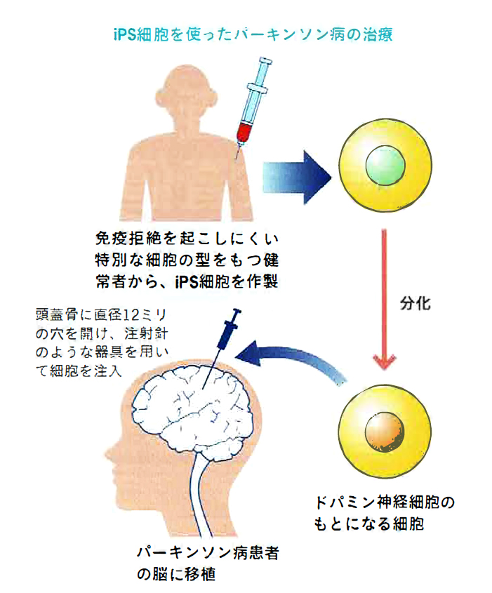 Ips細胞を用いたパーキンソン病治療 医療法人 松田脳神経外科クリニック