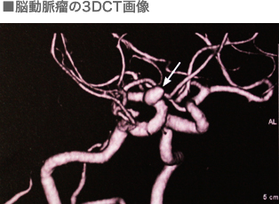 脳動脈瘤の3DCT画像
