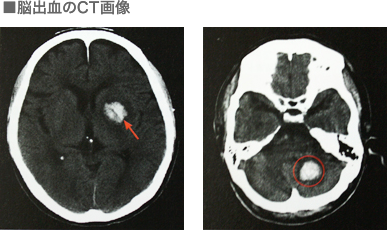 脳出血のCT画像